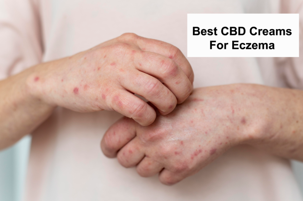 Best CBD Creams For Eczema